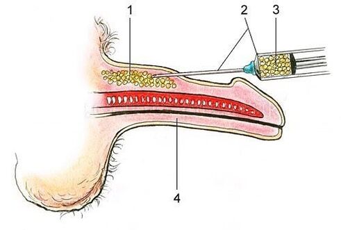 Injection of adipose tissue under the skin of the penis.