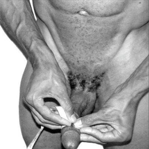 Measuring the penis before enlargement.