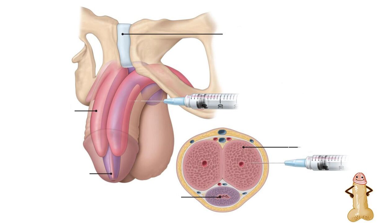 Hyaluronic acid injections to enlarge the penis. 